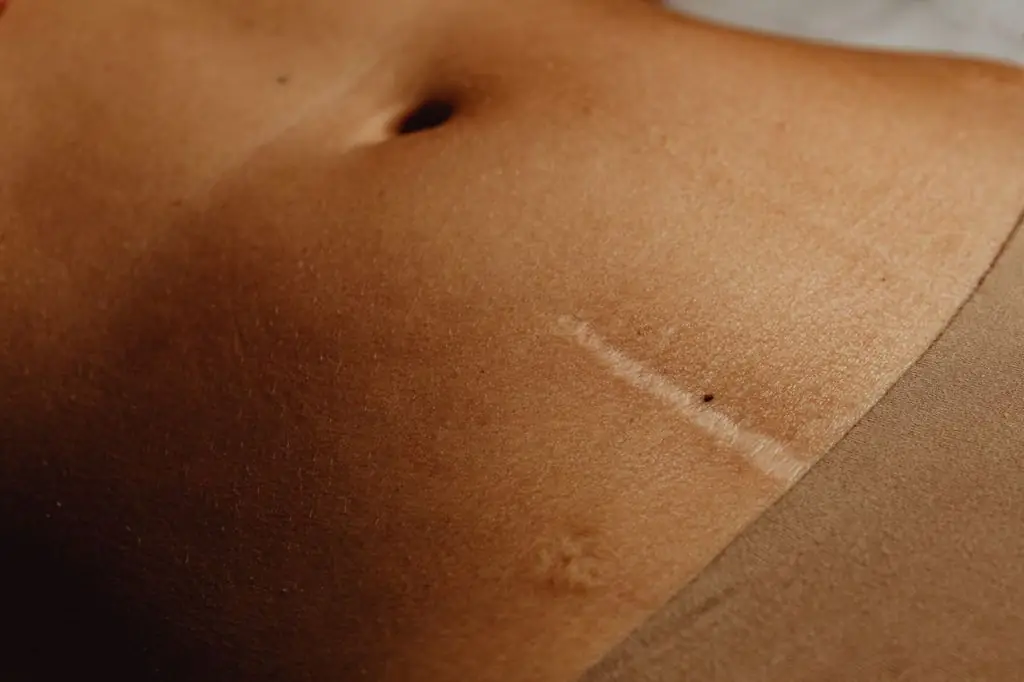 Pormenor de uma cicatriz abdominal em pele morena